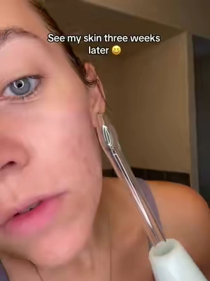Get it while it’s still on sale 😆 #highfrequencyfacialwand #highfrequencyfacial  #tiktokshopblackfriday #tiktokshopcybermonday 