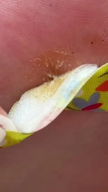 This Hyland’s drawing salve is literally magic ✨ @Hyland's  #prid #drawingsalve #splinterremoval #salve 
