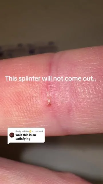 Replying to @Briar🐥 this PRID worked wonders on this splinter! 🤯 It only took a couple hours to soften this splinter up and draw it to the surface. We’re impressed every single time!!  #prid #drawingsalve #splinterremoval #splinter 