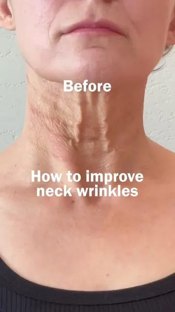 Before & After magic🪄 This routine visibly lifts, smooths, and firms your neckline. Try it and see the magic! 1️⃣Dr.Melaxin Necksphalt Neck Ampoule 2️⃣Dr.Melaxin Necksphalt Neck Cream 3️⃣Dr.Melaxin Necklinephalt Neck Cream #drmelaxin #dermarecipe #necksphalt #necklinephalt #neckline #neckwrinkles #wrinklecare #kbeauty #tiktokshop #tiktokmademebuyit