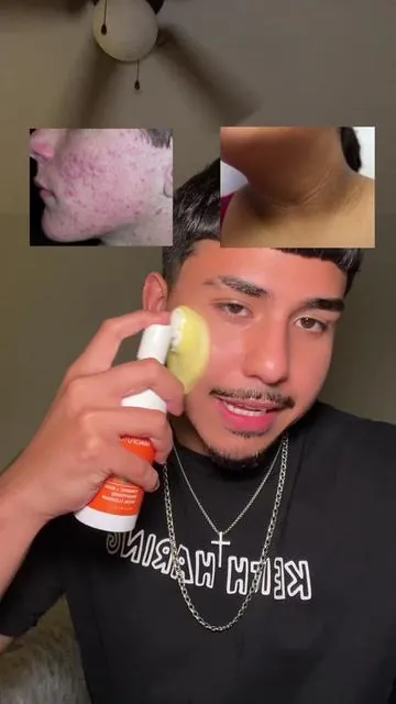 Start taking care of your skin. #darkspots #acne #turmericsoap #skincare #clearskin #foryou 