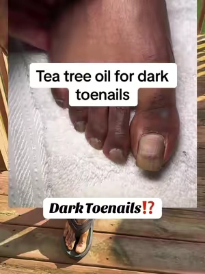 Hubby is so happy his toenails are looking so good🙌🏽🙌🏽🙌🏽 2 months in using tea tree oil from @GuruNanda LLC @Elizabeth  #teatreeoil #teatreeessentialoil #darktoenails #toenails #toenailfungas #feetcare #feet #nails #gurunanda #gurunandaproducts 