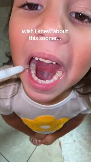 So far, so good with restoring my kids cavity great for sensitive teeth!! #ToothArmor #DentalCare #Cavities #OralHealth #DentalHygiene #ToothRepair #sensitiveteeth #DealsForYouDays #tiktokshopcreatorpicks 