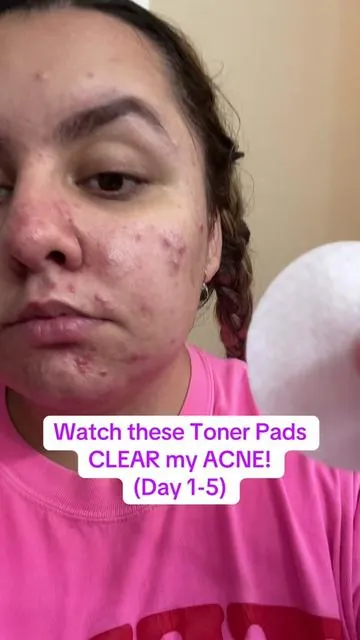 My HOLY GRAIL product in my skincare routine! I swear by the Medicube Toner pads. I use the Brown Vita C every morning and the Blue Pore every night now. Works great on my sensitive skin! #acnetreatment #acneskincare #medicube #tonerpad #acnetips #skincaretips #howiclearedmyacne @medicube global 