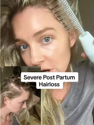 I started using the NuDerma high frequency wand with the Neon attachment (orange wands) after postpartum hair loss thinned my scalp and left my skin feeling dull. Argon is known to support circulation, stimulate follicles, and promote clearer skin. I use it 2–3x a week to support regrowth and glow—no needles, no meds, just postpartum repair with microcurrent ✨ I linked the more affordable wand I use for anti-aging + scalp care in the shopping cart 👇 #postpartumhairloss #highfrequencywand #postpartumskin 