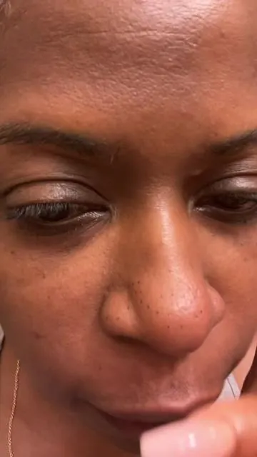 #blackhead #pimple #skincareroutine 