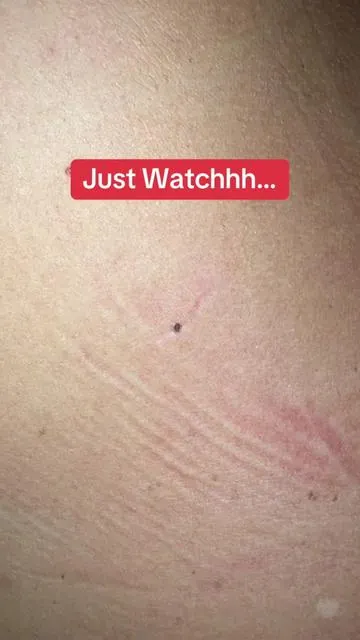 Watch this blackhead pop right out of my boyfriends back 👀 using the Dr. Melaxin Peel Shot!  #drmelaxin #blackheadremoval #peelshot  #blackheadpop #porecleanse  #oddlysatisfying @Dr.Melaxin Global 