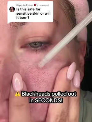 Replying to @Rosse 🌹 the white rice serum should be used on more delicate areas such as your face & neck. The black rice serum is perfect for more rough and bumpy areas! Both are perfect for sensitive skin, no burning!  #drmelaxin #peelshot #exfoliate #drmelaxinpeelshot  #blackheads #tiktokshopcreatorpicks  #TikTokshopbacktoschool #tiktokshopblackfriday 