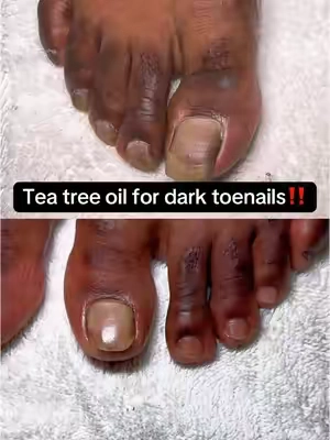 Tea tree oil has been a game changer for my hubbies toenails! @GuruNanda LLC @Elizabeth  #teatreeoil #darktoenails #toenails #nailfungus #nails #gurunandaproducts 