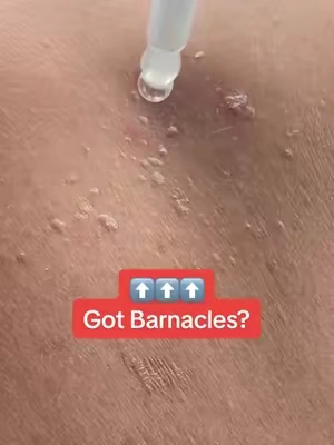 Seborrheic keratosis otherwise known as “barnacles of aging” can be taken care of with the De Melaxin peel shot ! Esthetician approved! Use code CREATORPIC to save 💰#barnacles #seborrheickeratosis #exfoliate #exfoliation #drmelaxin 