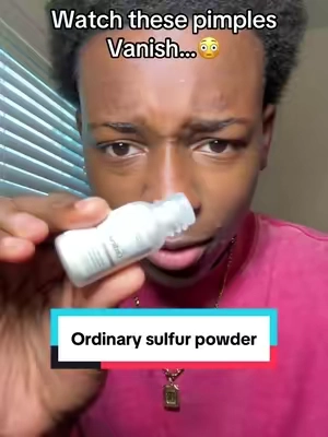 It’s crazy how good this works #sulfur #theordinary #skincare #acnetreatment #pimpletreatment #pimplepatch #tiktokshopfinds #tiktokshoplabordaysale 
