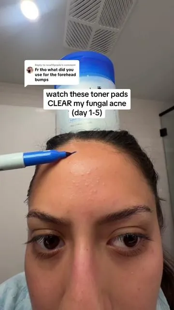 Replying to @rosa10prado Korean toner pads are the reason my forehead bumps are GONE!! I use the brown Vita C one in the morning and the blue pore one at night. I have super sensitive skin and they’ve been SOOO gentle but super effective 💕 #tonerpad #fungalacne #medicubesuperbrandday #tiktokshopcreatorpicks #acnetreatment 