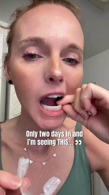 Only 2 days into this teeth whitening kit and I’m already seeing results! 😳 If you’ve been looking for the best teeth whitening kit, a safe way to whiten your teeth at home, or wondering how fast these products actually work — here’s my honest day 2 update. I’ll keep sharing my teeth whitening progress so you can see if this kit really delivers the results it promises. So far, my smile is already looking brighter after just 48 hours. ✨ ##teethwhitening##teethwhiteningkit##opalescence##teethwhiteningresults##tiktokshopcreatorpicks