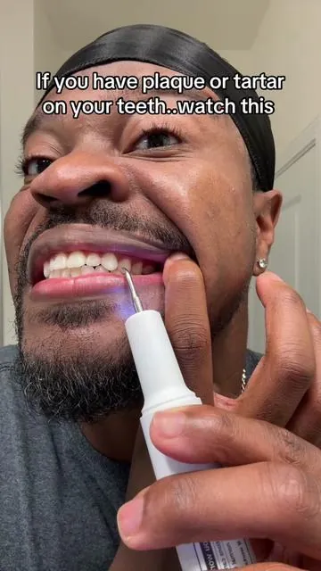 If you have plaque or tartar on your teeth..watch this #teeth #teethcare #tartar 