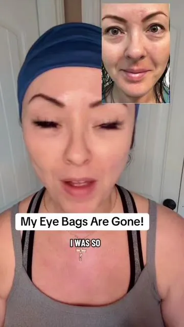 My Eye Bags Are Gone! @Dr Melaxin Official  #menopause #eyebags #puffyeyes #peptide #antiaging 