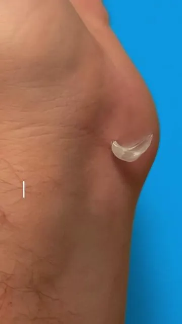 #prid #Infection #Wart #Splinter #abcess  