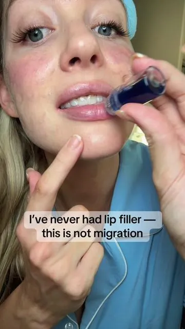 Everyone thinks this line is filler migration — but I’ve never had filler. I’ve been plumping my lips naturally with the Qure Micro Infusion Microneedling Set. Microneedling is known to stimulate collagen production and skin turnover, helping lips look smoother and fuller over time. A clean beauty alternative for moms who want results without injections. ✨ With consistent use over years, this has been part of my lip routine through my 20s into my 30s. ⸻ Disclaimer (add at the end of caption) Disclaimer: This is my personal experience, not medical advice. Results vary and require consistent use over time.  #Microneedling #tiktokshoprestock #QureSkin #TikTokShopCreatorPicks #TikTokShopBlackFriday