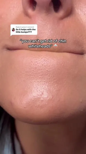 Replying to @gracy with Korean skincare, ANYTHING is possible. Make sure to double cleanse to remove those pesky whiteheads 🤢 #koreanskincare #whiteheads #doublecleansing #cleansingoil #acne 