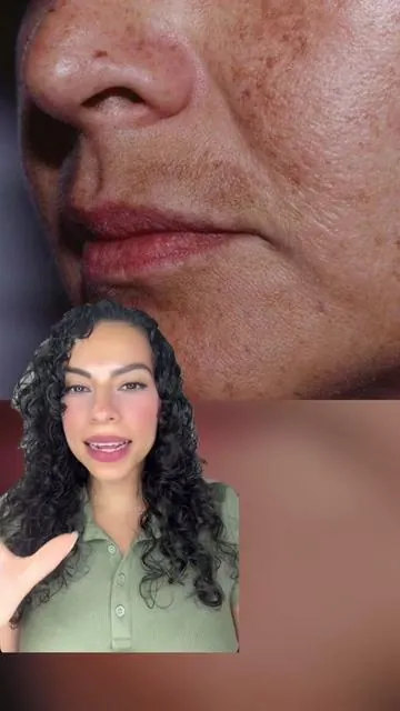 ✨Tip para eliminar la mancha del bigote✨ y recuerden que los resultados dependen del tipo de piel y la constancia en el uso del producto.  #darkspots #koreanskincare #antiagingskincare #tiktokshopcreatorpicks #koreanskincareproducts @celimax US Store 