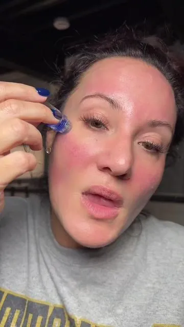 Transform your skincare routine with this at-home microneedle system, designed to boost collagen, improve elasticity, and target fine lines, wrinkles, and hyperpigmentation. For a limited time, get two months FREE when you buy two months—making this the ultimate anti-aging, wrinkle-prevention system that saves busy women time and money. @Qure Skincare .	#AntiAgingSkincare 	.	#WrinklePrevention 	.	#MicroneedlingAtHome 	.	#CollagenBoost #acnescarring  