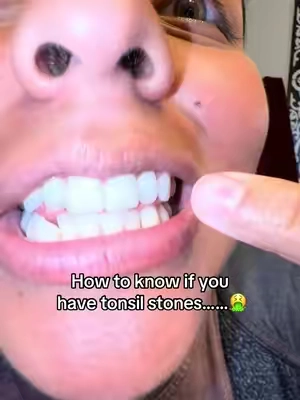 Why wasn’t this invented sooner…. #tonsilstones #badbreath #teethcare #tonsils #teethtok 