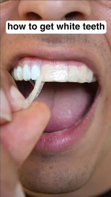How I whiten my teeth ✨ #fyp #braces #viral #bracesguy 