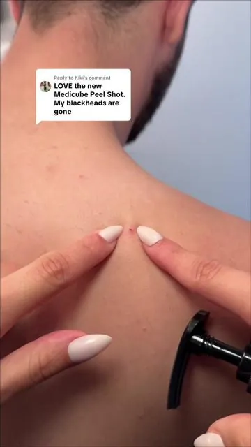 Replying to @Kiki removing my husbands blackheads with the new Medicube Peel shot. This stuff works too good 😭😭😭 #peelshot #tiktokshopblackfriday #tiktokshopcreatorpicks #medicubeskincare #koreanskincare 