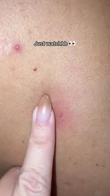 Dr Melaxin Tumeric Kojic Acid Peel Shot works like a charm #demelaxin #hyperpigmentation #exfoliate #peelshot #oddlfysatisfying  #tiktokshopblackfriday @Dr.Melaxin Global 