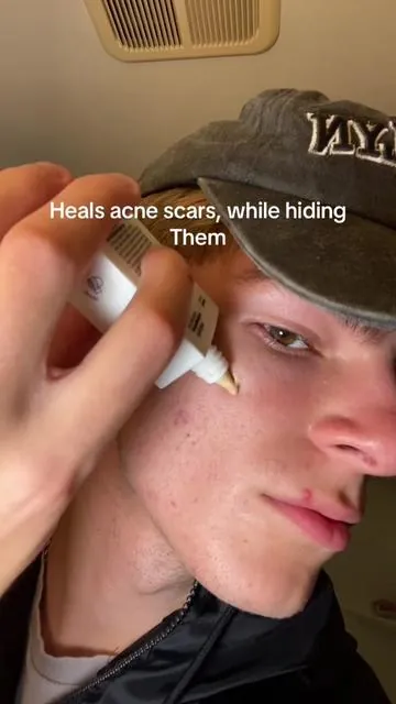 No more acne scars for me 🥀 #acnescars #tiktokshopblackfriday #tiktokshopcreatorpicks #looksmax 