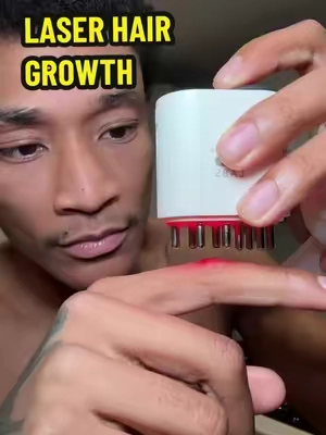 Laser hair growth is changing the game #hairgrowthhairline #hair #menshair #hairloss