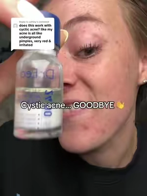 Replying to @ashley it’s hands down the best product I’ve used for my hormonal/cystic acne. 🙌 I’ve never ever seen it on this big of a sale so I’m stocking up cause my face will definitely make sure it gets its use 😂😂😂 #dryinglotion #drleo #cysticacne #tiktokshopcybermonday #tiktokshopblackfriday 