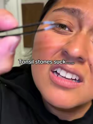 If your breath stinks, you may have tonsil stones #tonsils #badbreath #tonsilstones #teethcare #tiktokshopblackfriday 