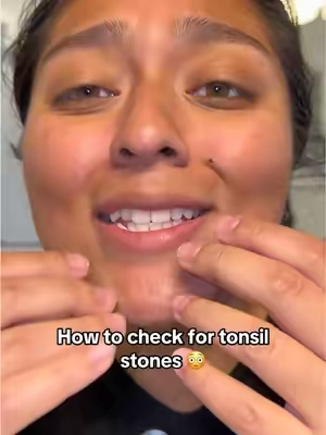 This really does make it so easy to clean 🤢🙌🏽 #tonsilstones #badbreath #teeth #tonsils #trendy 