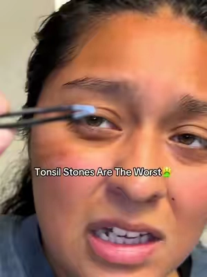 Not fun at all…. #tonsilstones #tonsils #badbreath #teeth #fyp 