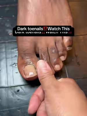 Tea tree oil is so useful! Use this daily for the dark toenails! @GuruNanda LLC @Elizabeth  #gurunanda #gurunandaoil #teatreeoil #darktoenails #toefungus 