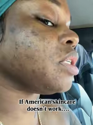 #skincareroutine #hyperpigmentation #glassskin #skincare #anua 