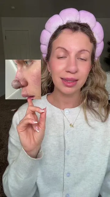 How I maintain the hair on my nose due to reconstructive surgery!