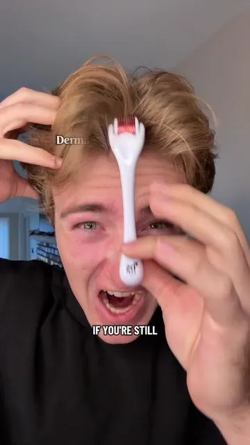 Derma rollers are sooo harmful! They can cause scaring and bleeding while offering no results! #hairgrowth #microneedling #dermastamp #dermaroller #hairgrowthproducts 
