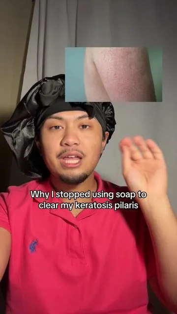If you have #keratosispilaris listen up