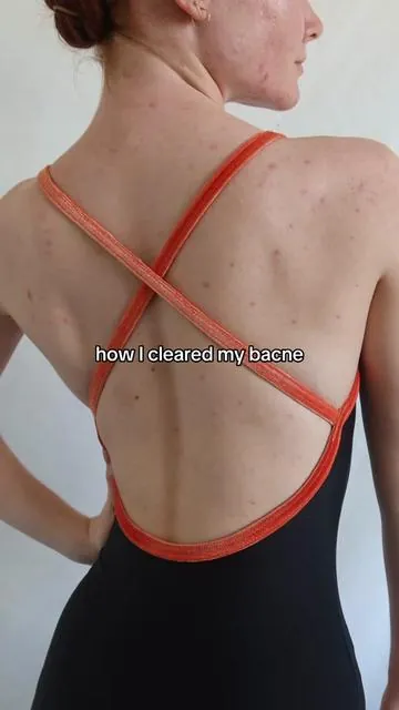 30 day transformation is unbelievable 😍 now I can wear tube tops in public 🥹 #somebymi #bacne #acne #bodywash #koreanskincare @SOME BY MI US 