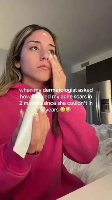my skin feels so free without them!! #skintok #Glowyp #skincare #acnescars 