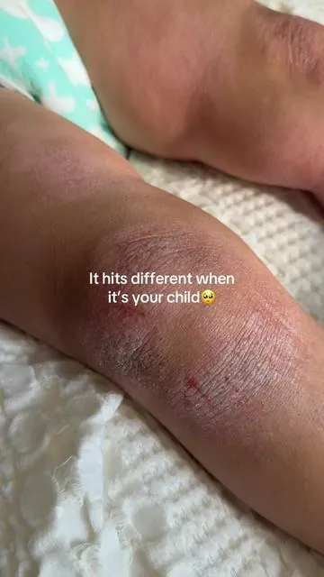 Last night was one of those hard eczema nights. Watching her scratch and not being able to fully rest breaks my heart every time. If you’re an eczema mom, you know this kind of tired. You’re not alone. #eczemamom #eczemahelp #sensitiveskin #MomsofTikTok #dryskin 