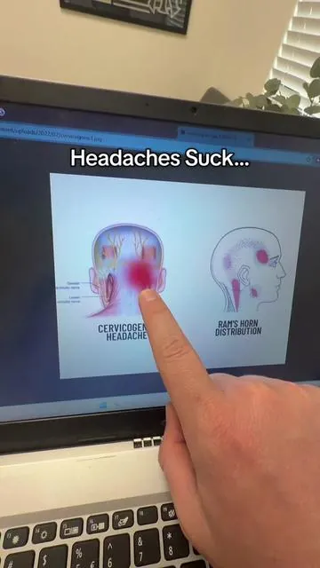 My go to suboccipital release for my cervicogenic headaches #headaches #headacherelief #headache #migrainerelief #migraine 