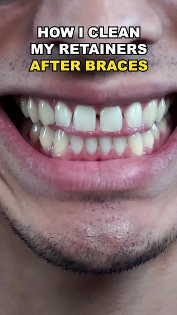 So much better!!  #gaptaincrunch #viral #fyp #TikTokShopCreatorPicks #braces 