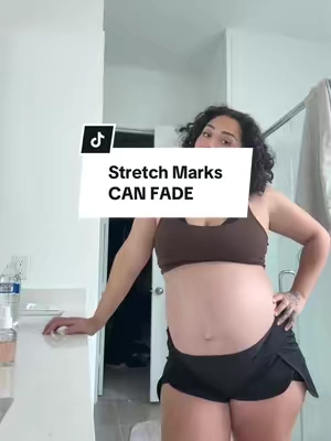 This is the most confident I’ve ever been with my stomach #beauty #skincare #stretchmarks #postpartum #pregnancy 