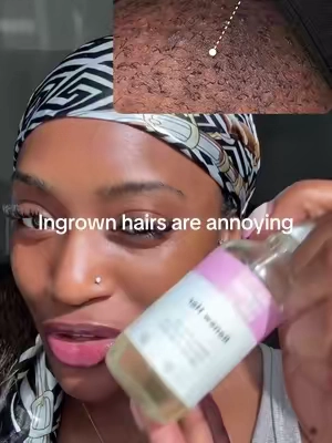 This is the one thing that works. Use it after your waxes or after you shave 🤍#renewheroil #herfantasybox #ingrownhairs #hyperpigmentation 