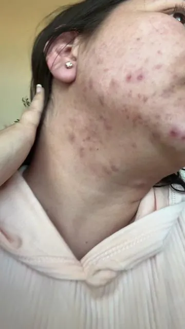 Acné adulto 😩 probé muchas cosas y esto sí me funcionó 🙌 #acne #cuidadodelapiel #skincare #niacinami #piellimpia  