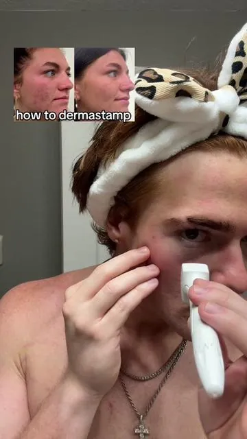 how to dermastamp properly 🤝 #dermastamp #looks #ascend #skincare #fyp 