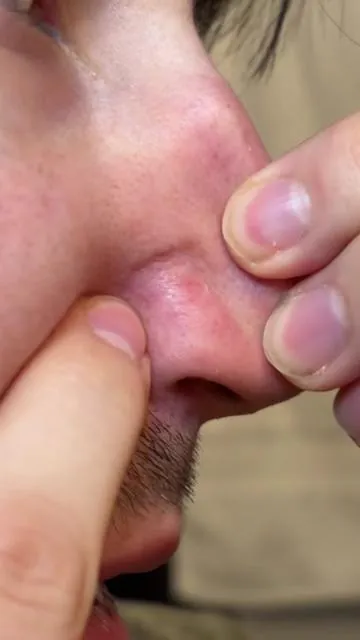 Finally a peel shot that CLOSES your pores after cleaning them #acne #blackhead #peelshot #drmelaxinpeelshot 