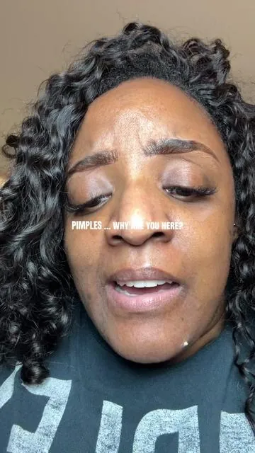 I’m convinced, PIMPLES just like to pop up unannounced. & we just have to be like “oh, HI” 😑 #TiktokShopCreatorsPicks #medicube #medicubeskincare #pimples #acneproneskin 